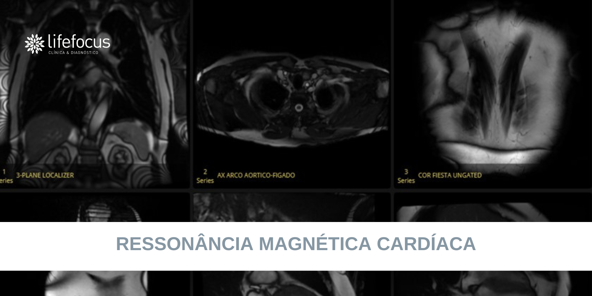 Ressonância Magnética Cardíaca – Lifefocus Estefânia